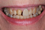 Fig 1. Patient with failed veneer No. 8 and dislodged crown No. 9.