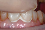 Fig 5. Central incisors were cemented with a calcium-silicate dual-cure resin cement.