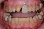 Fig 2. Treatment goals were to replace restorations on the central incisors and lighten color throughout the dentition.