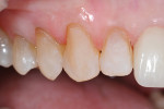 Fig 6. Teeth with veneers were totally etched for 20 seconds and rinsed.