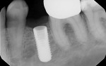 Fig 8. Radiograph showing the implant in site No. 20.