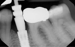 Fig 16. Final radiograph of implant and crown.
