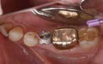 Fig 9. Occlusal view of conventional pick-up impression coping.