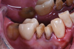 Fig 2. Prepared teeth Nos. 28, 29, and 31.