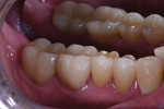 Fig 3. Post-cementation of crowns on teeth Nos. 28, 29, and 31.