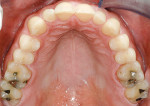Figure 5  Initial maxillary occlusal view.