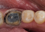 Figure 4  Image of a preparation with a poor substrate and subgingival margins where maintaining the seal would be difficult. High-strength ceramics or metal-ceramics would be indicated.