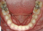 Figure 6  Initial mandibular occlusal view.
