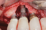 Fig 3. Clinical view of reflection of the area following decontamination of the dental implant surfaces with citric acid and air powder abrasion. This combination lesion was absent the facial, mesial, and distal walls and had a palatal moat.