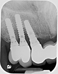 Fig 2. Pretreatment radiograph of the area suggested advanced bone loss that appeared to emanate from the canine implant and was affecting the two adjacent implants. The marginal fit of the posterior two splinted implants was less than optimal.