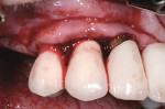 Fig 8. The site was treated with an Nd:YAG laser to ablate any residual materials present in the soft tissue, including titanium debris and bacteria.