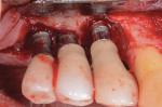 Fig 14. The lesions on these implants had bone loss that precluded them from receiving regenerative therapy.