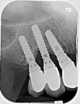 Fig 9. Radiograph at 3 years suggested favorable gain in hard tissue secondary to the surgical procedure. A slight angular deformity remained at the distal of the canine implant but had greatly improved.