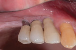 Fig 11. Pretreatment view of maxillary right first molar and first and second premolar dental implants. Severe inflammation was evident and purulent exudate was elicited by pressing on the tissue.