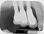 Fig 12. Pretreatment periapical radiograph suggested moderate bone loss on
the implants.