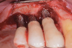 Fig 15. Implantoplasty was performed on the implants following their decontamination with air powder abrasion with glycine and citric
acid.