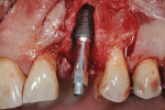 Fig 3. Implant placement with resonance frequency testing abutment confirming initial implant stability reading.