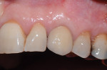 Fig 7. Seven-year postoperative clinical photograph (case courtesy of Paul S. Rosen, DMD, MS).