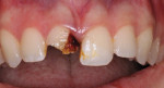 Fig 1. The patient’s initial presentation with fractured tooth No. 8.