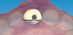 Fig 6. CAD/CAM design of provisional crown, occlusal view.