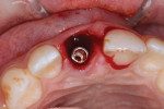 Fig 3. Implant placed toward palatal aspect.