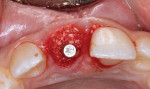 Fig 4. Particulate corticocancellous bone graft used in the buccal gap.