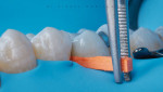 After the area was cleaned, a dental wedge was inserted in order to create space.