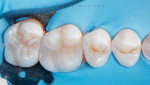 Composite placed in small increments, shaped, and light cured.