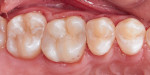 Side-by-side comparison of the pretreatment failed amalgam restorations and the final polished composite restorations.
