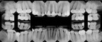 Pretreatment full-mouth series of radiographs showing extreme wear on the mandibular
anterior teeth and premolars.