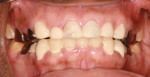 Pretreatment retracted facial view following preparation and placement of a temporary mandibular prosthesis.