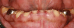 Pretreatment retracted facial view
of mandibular anterior teeth after removal of the temporary prosthesis, showing a significant loss of vertical dimension.