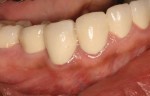 One-year posttreatment retracted right lateral view of the final restorations.