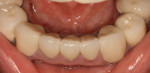 One-year posttreatment retracted occlusal view.