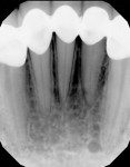 Comparison of pretreatment radiograph and
1-year posttreatment radiograph.