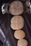 Preoperative photograph of failing composite restorations on teeth Nos. 29, 30, and 31.