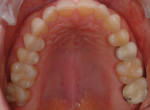 Pretreatment occlusal view of the maxillary
arch. Note the crowding of the maxillary anterior teeth and how tooth No. 13 was pushed buccally.