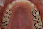 Pretreatment occlusal view of the maxillary arch with the existing composite restorations
outlined.