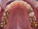 Final posttreatment occlusal view of the maxillary arch. Note the similarity between the outlines of the gold inlays and the previous restorations (indicating conservation of tooth structure), the realignment of the anterior teeth, and the movement of tooth
No. 13 lingually.