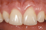 Figure 8  Initial view, maxillary anterior teeth.