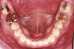 Fig 6. A defective restoration is present on tooth No. 18, as well as a questionable restoration on tooth No. 30. Teeth Nos. 19 and 31 had a hopeless prognosis. Teeth Nos. 20 through 28 showed signs of erosion and attrition.
