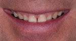Fig 7. The preoperative close-up smile shows small size and proportion of teeth and visible tissue display.