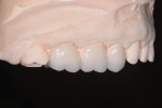 Fig 11. The buccal view of the AVO restorations on the working cast demonstrates finish lines in facial enamel.