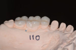 Fig 12. The palatal view of the AVO restorations is displayed on the working cast.