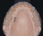Fig 14. Maxillary posterior monolithic lithium-disilicate restorations and layered zirconia anteriors are prepared for delivery according to the manufacturer’s recommendations.