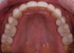 Fig 15. Postoperative, arch form is improved, volume is added to the facial of teeth, and the palatal surface of the anteriors are covered and restored to protect areas of erosion and attrition.