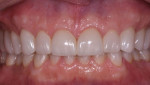 Fig 16. The overbite is reduced from 100% to 50%, the crowns are lengthened, and the posterior occlusal plane is flattened.