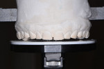 Fig 21. Evaluation of the upper study cast to the platform of the Kois facial plane-analyzer clearly demonstrates the additional tooth length added to the maxillary teeth.