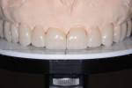 Fig 22. The final restorations to the platform demonstrate improved esthetics created by leveling the maxillary occlusal plane and adding the horizontal volume.