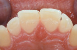 Figure 9  Lingual initial view, maxillary anterior teeth. Note moderate attrition.